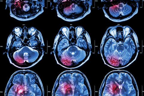 Does an MTHFR Mutation Increase the Risk of a Stroke? Does an MTHFR Mutation Increase the Risk of a Stroke?