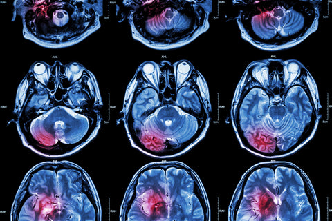 Does an MTHFR Mutation Increase the Risk of a Stroke?