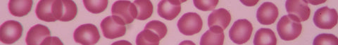 Homocysteine and Hyperhomocysteinemia: Hard to spell. Easy to manage