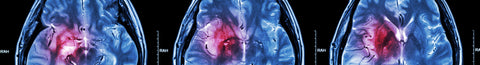 Does an MTHFR Mutation Increase the Risk of a Stroke?