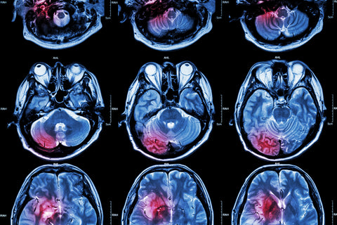 B Vitamins And The Risk Of A Stroke