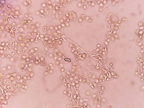 MTHFR Candida Infections and the Gut Brain Connection Methyl-Life Supplements MTHFR Candida Infections and the Gut Brain Connection Methyl-Life Supplements